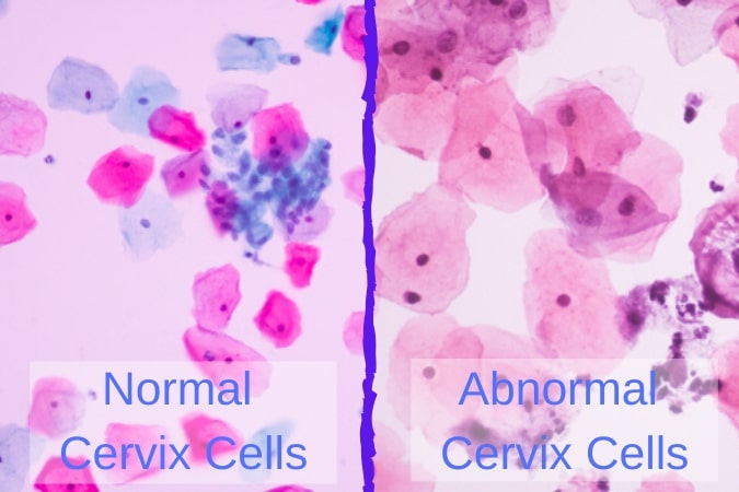 Normal vs Abnormal Cervix Cells