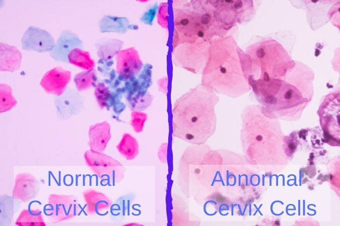 Epithelial Cell Abnormality All You Need To Know